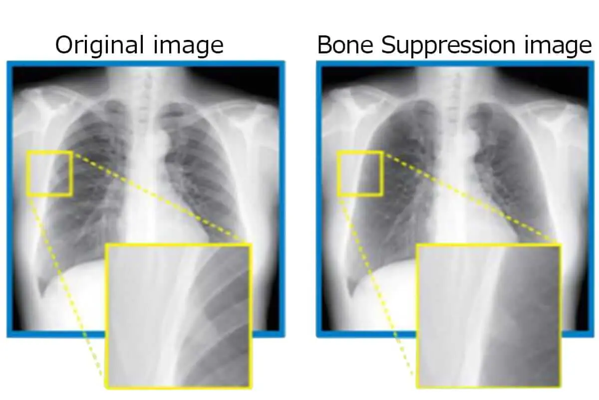 BS providing strong support for chest radiography diagnosis.