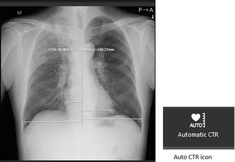 Auto cardio thoracic ratio (Auto)CTR