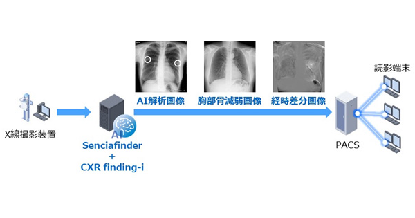 AIで医師の負担軽減に寄与する胸部X線画像診断支援ソフトウェア「CXR